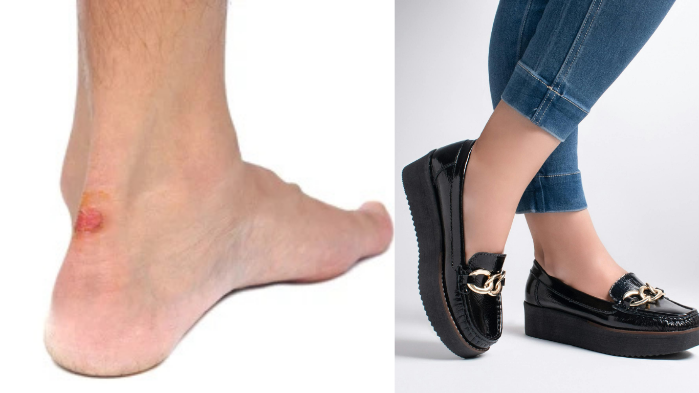 shoe bite from new shoes