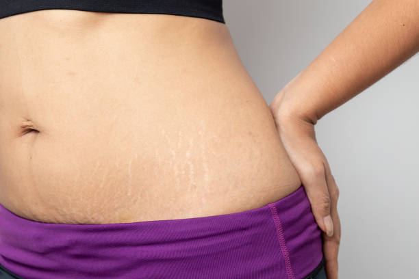 essential oils for Stretch Marks